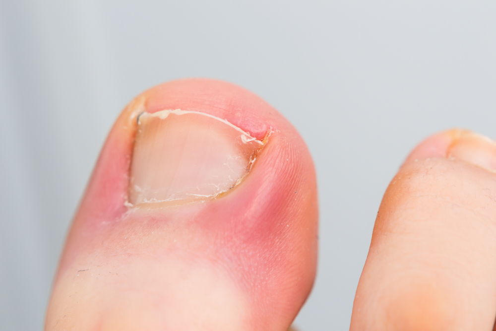 ingrown nail