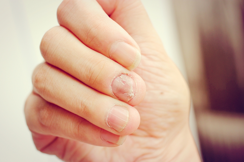 Fungus,Infection,On,Nails,Hand,,Finger,With,Onychomycosis.,-,Soft