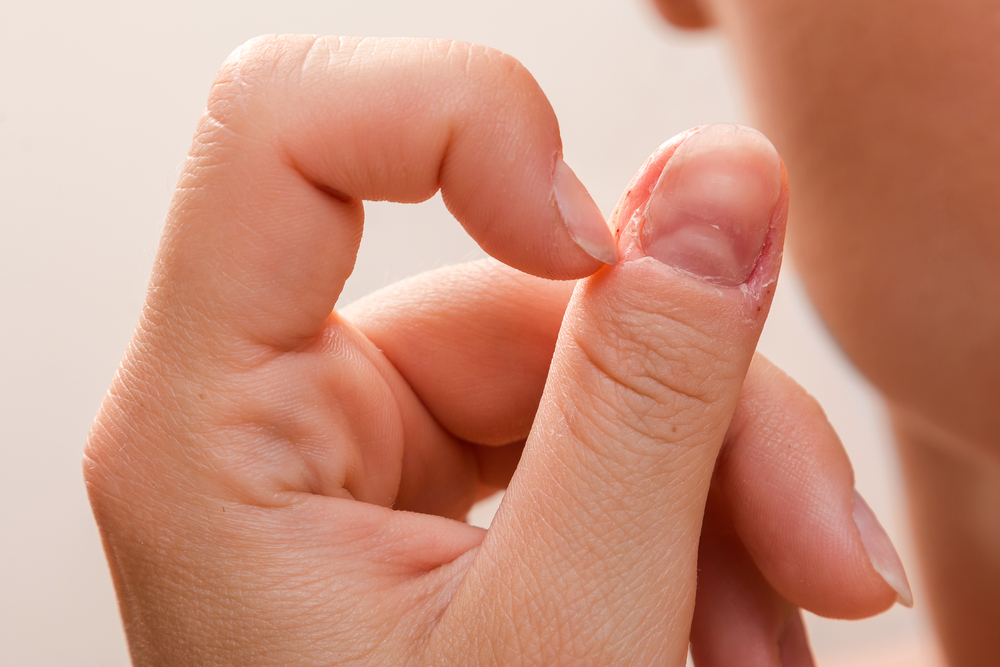 Close,Up,Of,Injured,Female,Finger,After,Biting,Nails